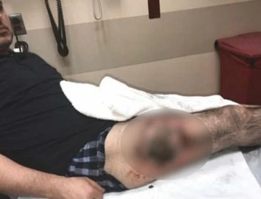 Απίστευτο: Έσκασε η μπαταρία στην τσέπη του και του έκαψε το πόδι (φωτο)